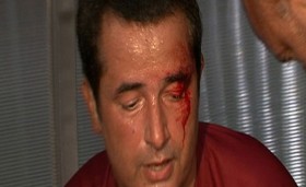 Acun Ilıcalı yaralandı acun ilicali kasi yarildi