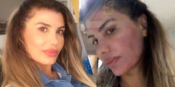 Ünlü şarkıcı Hatice’nin yüzü yandı